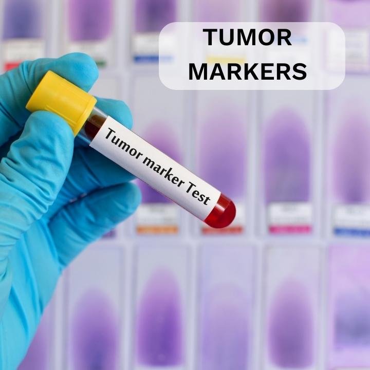 TUMOR MARKERS PHOENIX CLINICS AND DIAGNOSTICS